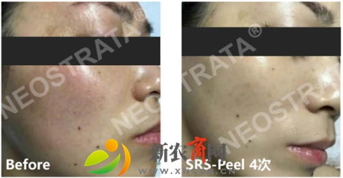 面部潮红症状显著缓解，肤色更显白皙眼周及整体肤质细腻，肤色显著提亮.jpg