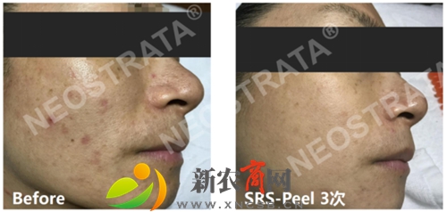 肤色均匀，痘印淡化，肤质细腻度明显增加.jpg