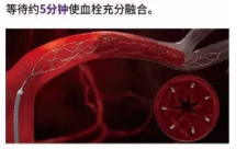 微导管穿过血栓，释放取栓支架，等待血栓融合，支架取出血栓，造影见远端血管通畅，取栓后大脑中动脉远端显影，血流恢复。2.jpg