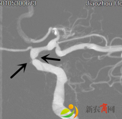 颈内动脉（后交通段）重度狭窄.jpg