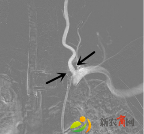 椎动脉Bridge支架植入后，管腔.jpg