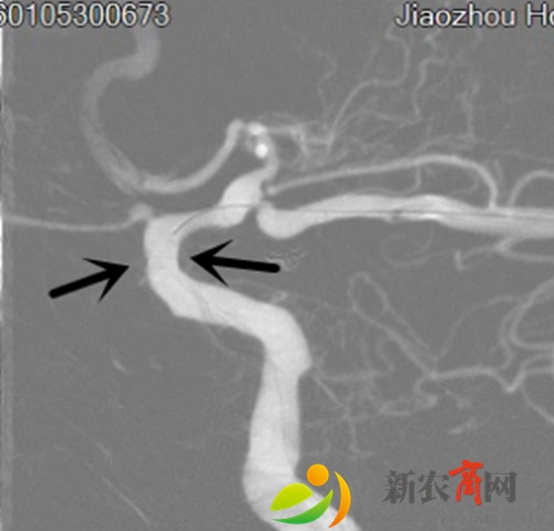 颈内动脉Atlas支架植入后.jpg
