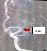 反复狭窄闭塞3.jpg