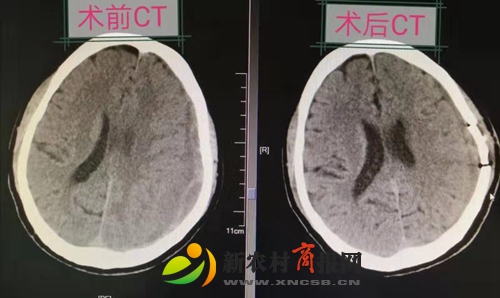 胶州市人民医院采用内镜技术与“锁孔”结合成功治疗复杂慢性硬膜下血肿