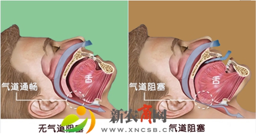 什么样的人容易患0SAHS？.jpg