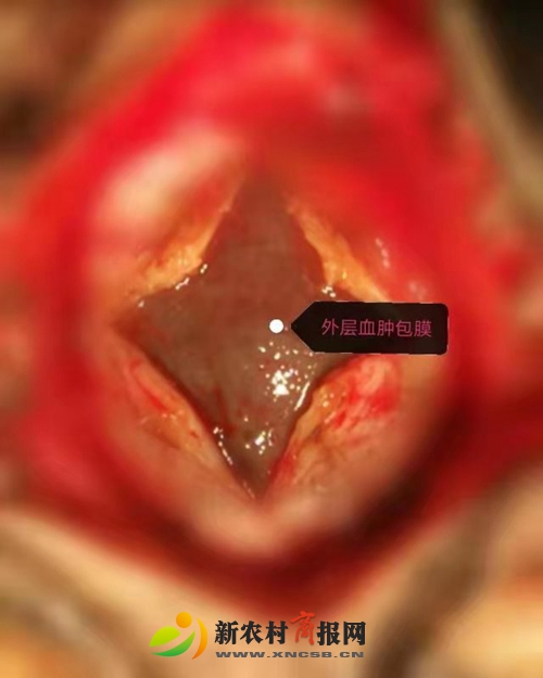 胶州市人民医院采用内镜技术与“锁孔”结合成功治疗复杂慢性硬膜下血肿