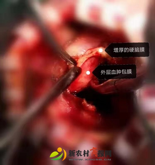 胶州市人民医院采用内镜技术与“锁孔”结合成功治疗复杂慢性硬膜下血肿