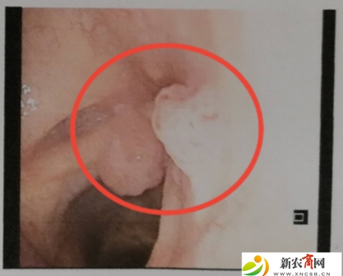 奥林巴斯电子纤维喉镜下可见室带、声带多发肿物.jpg