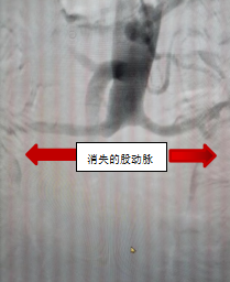 术后主动脉造影正常股动脉图片.jpg