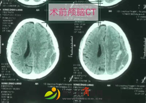 胶州市人民医院采用内镜技术与“锁孔”结合成功治疗复杂慢性硬膜下血肿