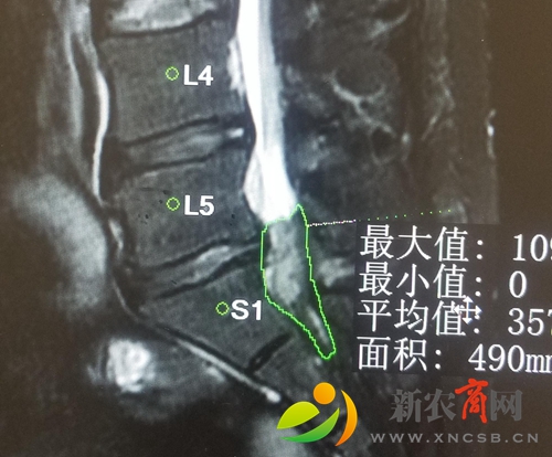 术前磁共振显示巨大椎间盘脱出游离到椎管中压迫马尾神经.jpg