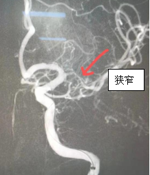 反复狭窄闭塞2.jpg
