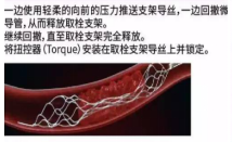 微导管穿过血栓，释放取栓支架，等待血栓融合，支架取出血栓，造影见远端血管通畅，取栓后大脑中动脉远端显影，血流恢复。.jpg
